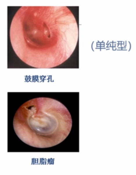 常见的听觉系统疾病