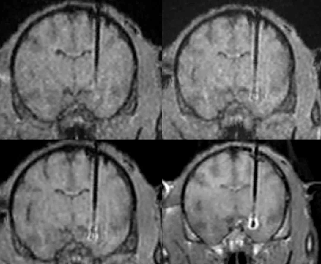 精准靶向治疗帕金森病：实时磁共振引导干细胞移植技术突破