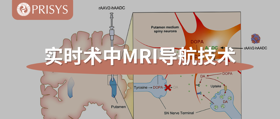实时术中MRI导航技术：助力FDA批准首个AADC缺乏症基因疗法