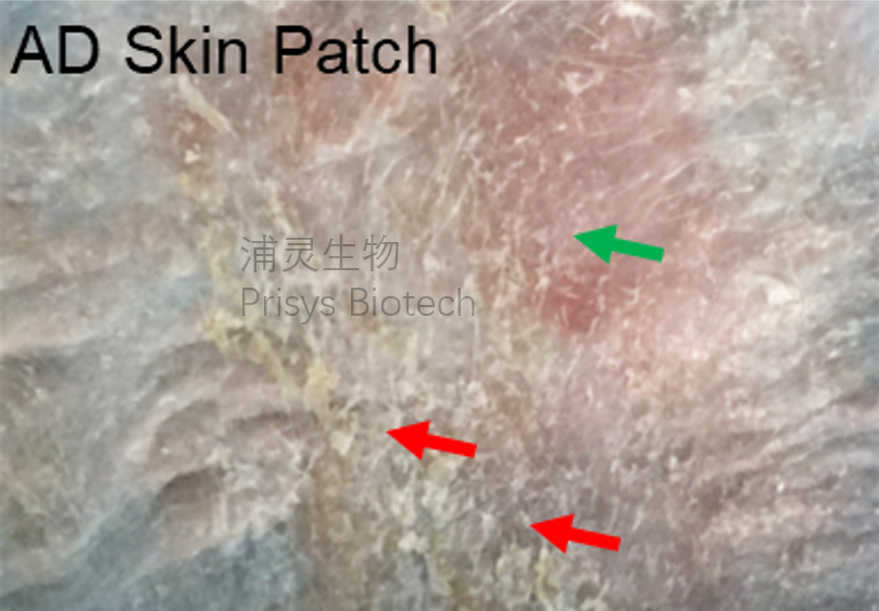 动物疾病模型 | 浦灵生物非人灵长类特应性皮炎(Atopic Dermatitis)模型