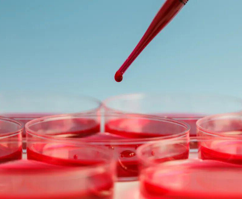 Beta thalassaemia Major