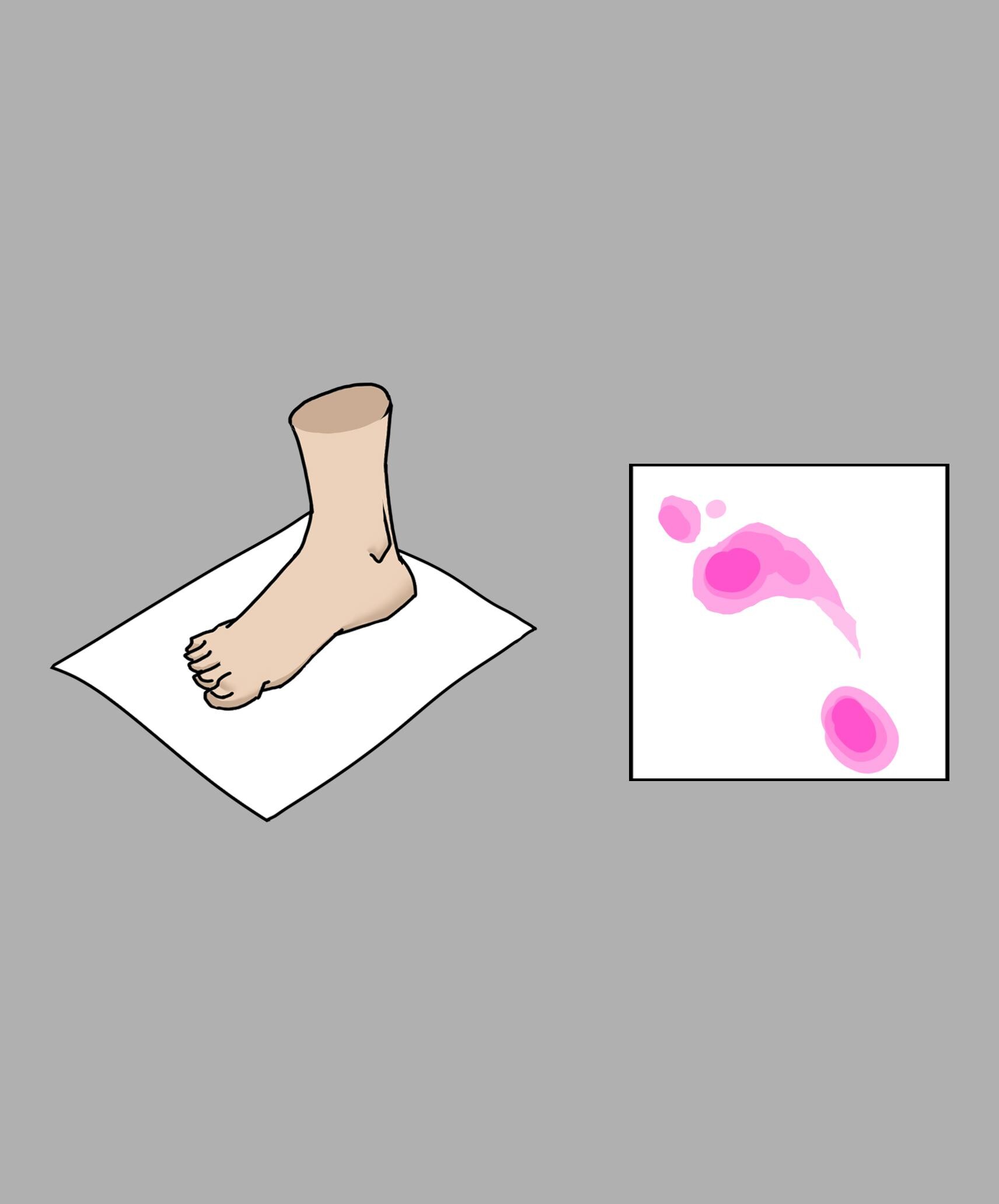 Biomechanical Application of sole plantar pressure