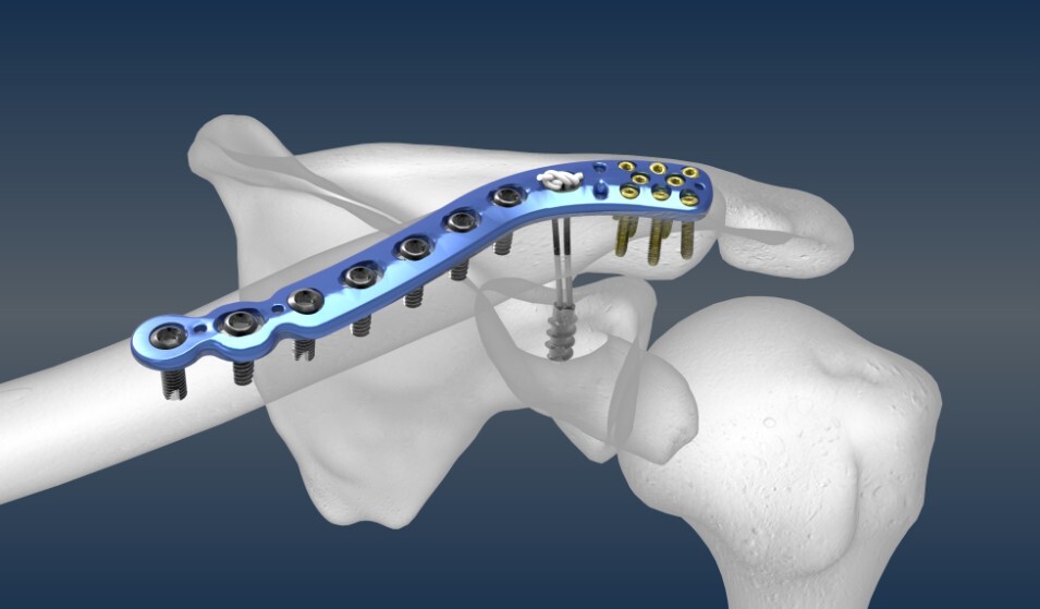 Tornillo óseo y placa ósea Tornillo óseo y placa ósea